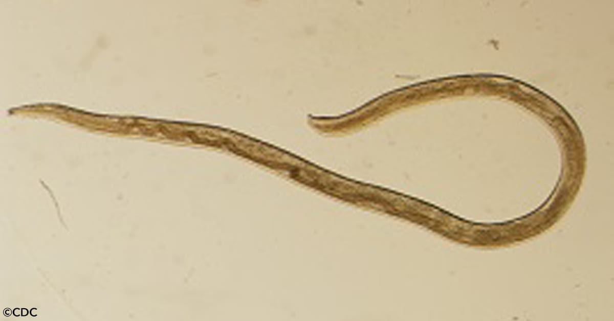 A Second Woman Pulls Parasitic Eye Worms out of Her Eye, and Doctors