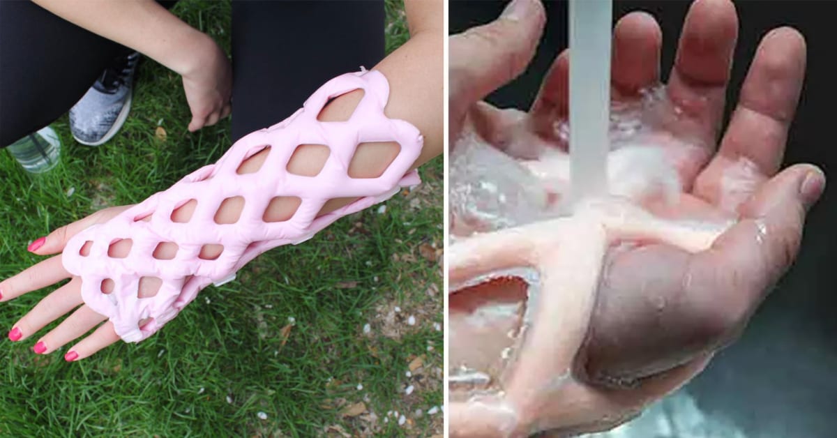 Engineers Create A Breathable And Waterproof Cast To Replace Plaster Ones  And Stop The Itching Forever