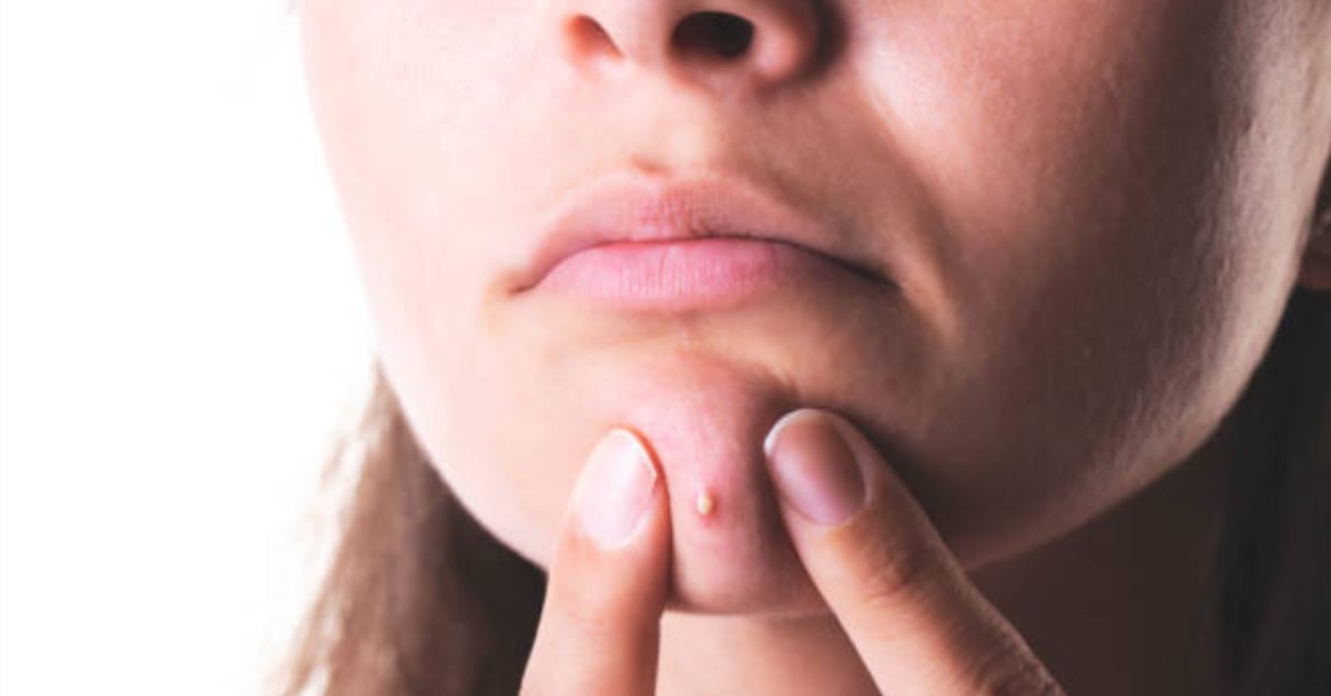 Popping zits can give you an infection. — 8 Things You Enjoy That