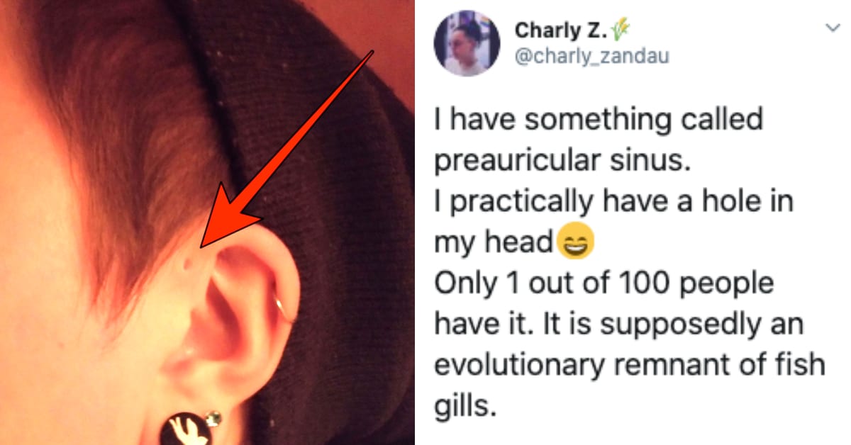 Some People Have Tiny Little Holes Above Their Ears