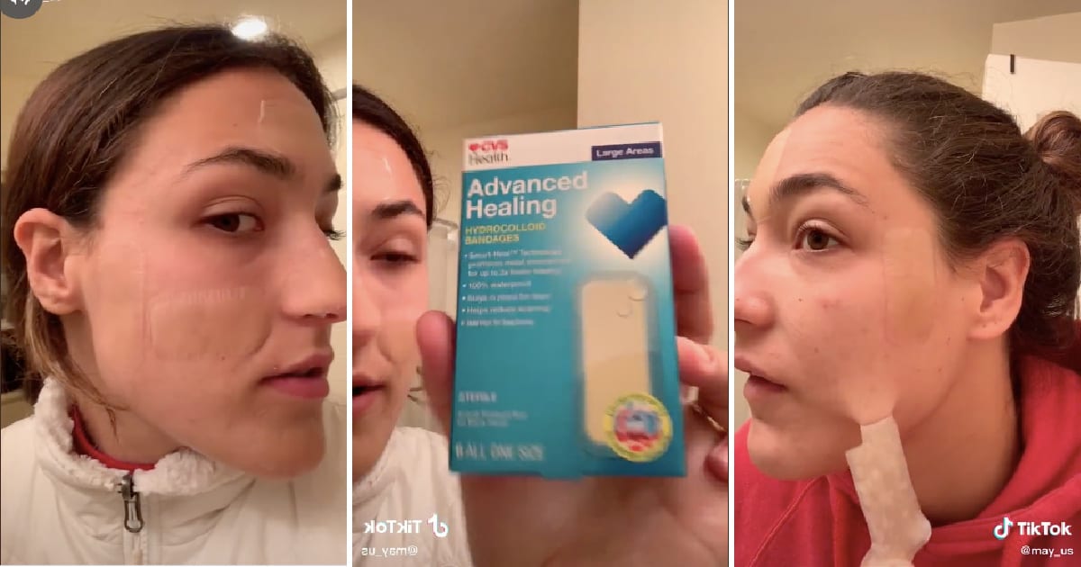 This Super Easy BANDAID Hack Can Help Your Acne Disappear